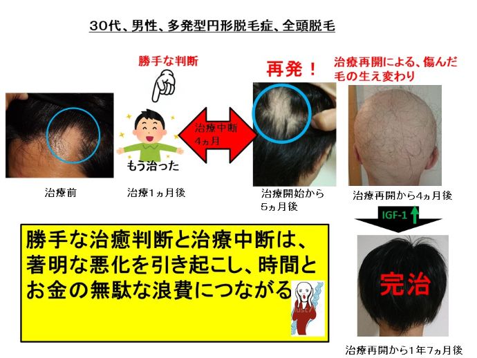 円形脱毛症　病院